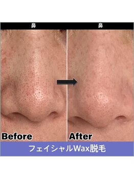 サロンシュシュ(salon Chou Chou)/フェイシャルwax 部分脱毛