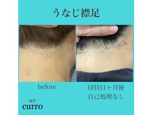 アクト クロ(ACT curro)/【うなじ襟足】脱毛施術例