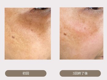 レイール(Reir)/WOVEstyleプレミアムコース