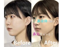 ラプリ 大宮店(Raplit)/隆鼻＋輪郭矯正40分10回