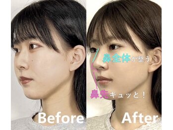 ラプリ 大宮店(Raplit)/隆鼻＋輪郭矯正40分10回