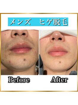 ベリッシモ 酒田店(Bellissimo)/ヒゲ脱毛ビフォーアフター
