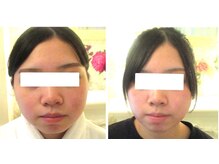 サロンドエステケイワイ(de KY)/フェイシャル☆小顔・タルミ改善