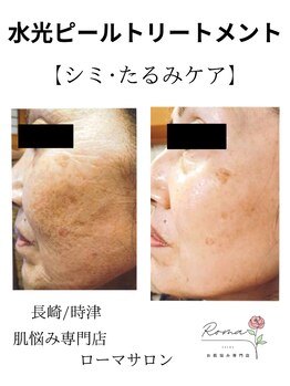 ローマサロン/シミ、たるみケアで10歳若い肌へ