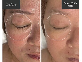 メロー(MELLOW)/プラズマスター