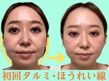 ナチュラルパーフェクトフェイス 新宿/35才・タルミ・ほうれい線/新宿