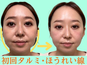 ナチュラルパーフェクトフェイス 新宿/35才・タルミ・ほうれい線/新宿