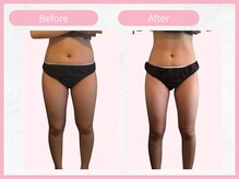 RHB 横浜店/【痩身コース】ビフォーアフター