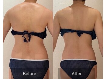 ルナスーリヤ 表参道店/痩身before　after