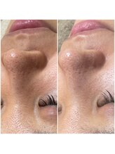 モンクラッシー(Mon classy)/1回で毛穴の黒ずみも◎