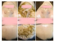 ストーリー(STORY)/ハーブピーリング専門店STORY