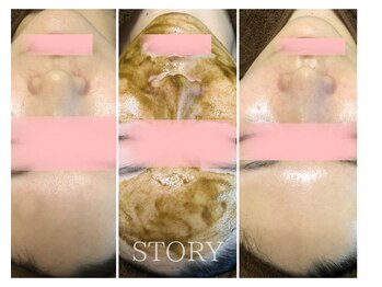 ストーリー(STORY)/ハーブピーリング専門店STORY