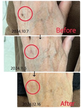 ソレイユ/光エステでシミケア♪