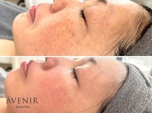 アベニール 芦屋/肌質改善ビフォーアフター