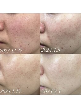 みるん(milne.)/洗うスキンケアが鍵となります！