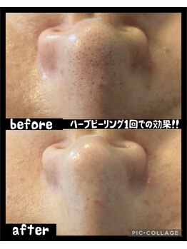 ラキュア(La Cure)/ハーブピーリングで毛穴ケアも！