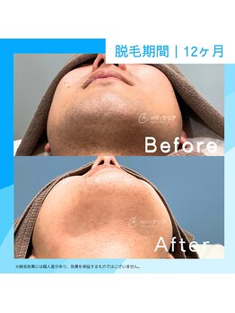 メンズクリア 難波店/【メンズクリア】お客様の施術例