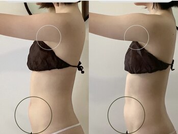 エミィ(emmy)/たった1回で変化！Before→After