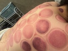 骨気(コルギ)専門店 YONG miu【ヨング ミュー】/カッピング【首肩こり】