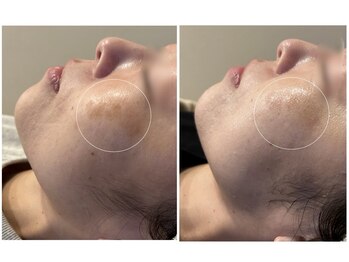 フイユ(feuille)の写真/「こんなところシミあった？」隠すケアから未来の輝きへ！ニキビと同時にエイジングケアも◎