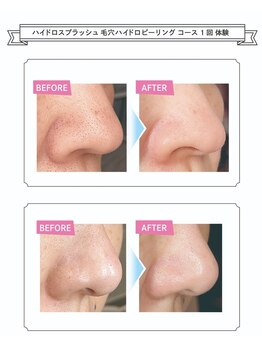 エクラ/毛穴洗浄ハイドロフェイシャル