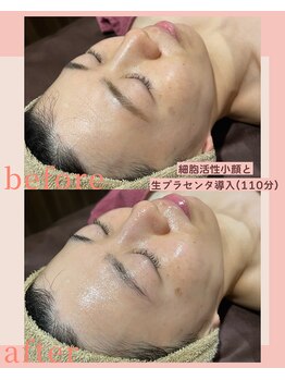 シストワ(sistoi)/☆細胞活性小顔と生プラ導入☆