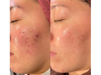 グッドライフエステ/肌質改善トリートメント