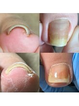 キュア(Cure.)/巻き爪補正ジェルネイルサロン