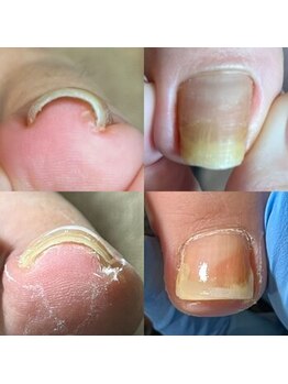 巻き爪補正ジェルネイルサロン