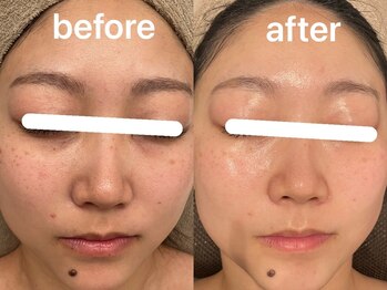 ヴィセラ(Vicella)/ラミピール施術経過