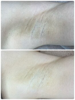 エクラルム(Eclaleum)/BeforeAfter　ララシークレット