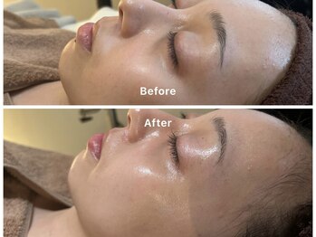 サロンアルーナ(Salon a Luna)/剥離なしハーブピーリング