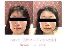 デアルーチェ(DEA LUCE)/小顔矯正＋ハイパーナイフ小顔