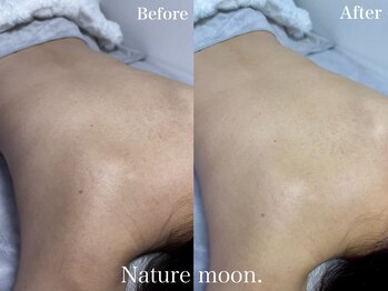 ナチュールムーン(Nature moon.)/背中ハーブピーリング