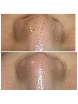 ストック(stock)/小さな黒ずみも除去