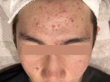 オアシスラグーン(OASIS LAGOON)/ニキビケア（症例６：before）