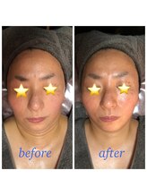 ラヴィソンファム(Ravissant femme)/VIハーブピーリング