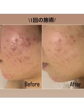 メナードフェイシャルサロン 片町店/一目瞭然！肌荒れ徹底ケア◎