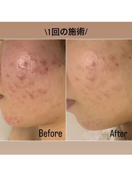 メナードフェイシャルサロン 片町店/一目瞭然!肌荒れ徹底ケア◎