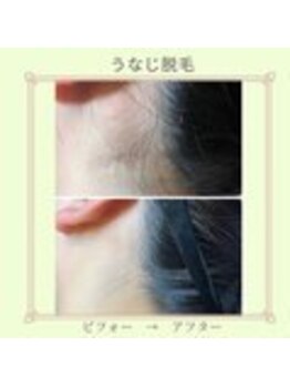 ノノ(nono)/うなじ脱毛♪