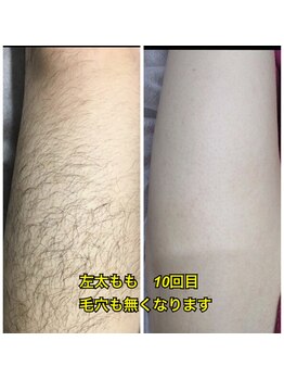 エピラージュ 町田店/全身脱毛
