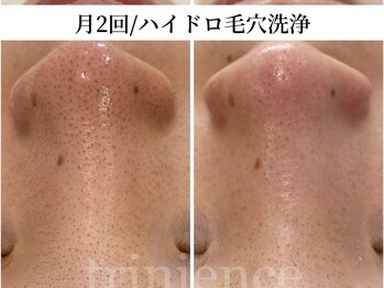 トリニエンス 南流山店/20代/ハイドロ毛穴洗浄