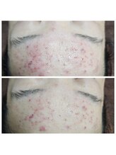 エターナル(Eternal)/ニキビケアにも有効