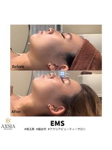 アクシア ビューティー サロン(AXSIA)/【EMS】BeforeAfter