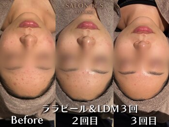 サロン ド エス アオヤマ(SALON DE S AOYAMA)の写真/青山・外苑前で本場韓国肌管理。ララピール×LDMで毛穴・ニキビ改善。水光肌を叶える最新の肌育エステ。