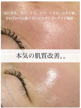 アスピリア(aspirer a')の写真/【本気の肌質改善】シミ/シワ/たるみ改善専門！韓国式肌管理×最新施術で、年齢肌を根本から変える本格ケア