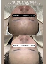 リンフェイス 表参道(RIN FACE)/ヒト幹細胞(乳歯髄100%使用)