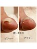 《つらい、巻き爪ケアに◎》　巻爪矯正１本