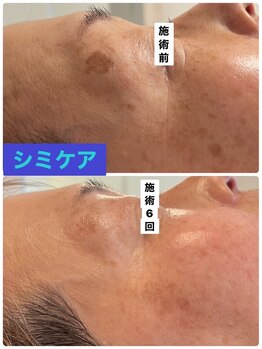 プリュネル(Prunelle)/シミケア