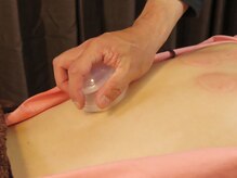 鍼灸オオクニ多肥(鍼灸okuni多肥)/カッピング後のオイルマッサージ